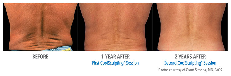 coolsculpting-2year
